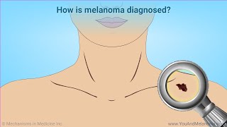 Diagnosing Melanoma [upl. by Fira]