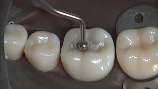 Class I Amalgam Preparation amp Restoration  Operative Dentistry [upl. by Aan]