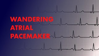 Wandering Atrial Pacemaker  EKG ECG Interpretation [upl. by Ilyak]