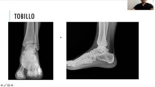 Radiología simple de miembro inferior [upl. by Ruelle]