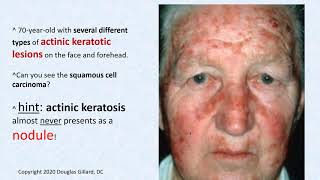 Dermatology wk5Win21 Actinic Keratosis [upl. by Naitsirc447]