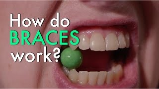 How Do Braces Work [upl. by Lhok]