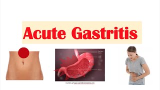 What is Gastritis  The GutDr Explains 3D Gut Animation [upl. by Arymat]