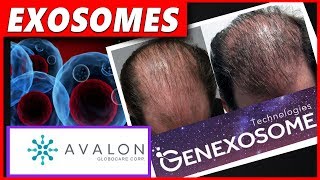 5 Things about Exosomes and Hair Loss [upl. by Agamemnon]