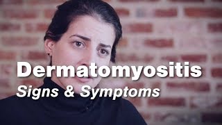 Dermatomyositis – Signs amp Symptoms  Johns Hopkins [upl. by Anaiek68]