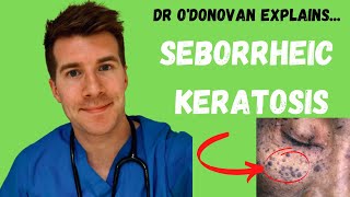 Explaining Seborrheic Keratosis  With Dr ODonovan [upl. by Zach]