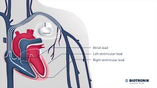 Cardiac Resynchronization Therapy – How it works [upl. by Nirmak]