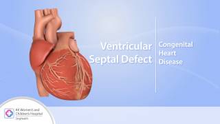 Heart Conditions – Ventricular Septal Defect VSD [upl. by Nnylaj]