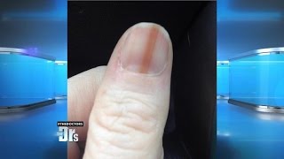 Melanoma on Your Nail [upl. by Inanak]