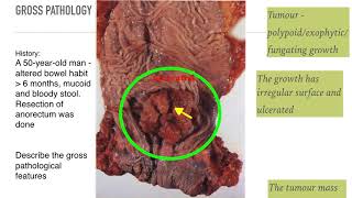 Understanding NonSmall Cell Lung Cancer [upl. by Lais]