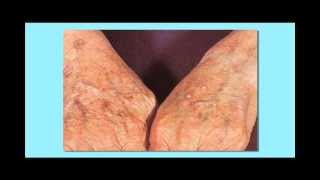 Actinic Keratosis Precancerous Skin Cancer [upl. by Attenweiler]