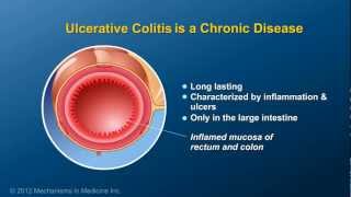 What is Ulcerative Colitis [upl. by Bertold703]