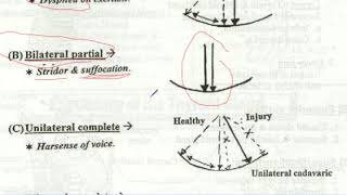 recurrent laryngeal nerve injury paralysis palsy [upl. by Enailil]