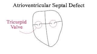 Atrioventricular Septal Defect AVSD [upl. by Naujit]