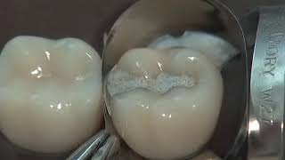 Class II Amalgam Preparation amp Restoration  Operative Dentistry [upl. by Haim]