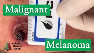 What Does Melanoma Look Like  Skin Cancer [upl. by Guenevere829]