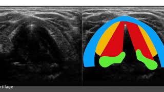 Neck Larynx Vocal cord paralysis [upl. by Corwin]