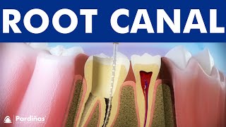 ROOT CANAL treatment step by step  3D video of endodontics for tooth decay © [upl. by Neelhtak466]