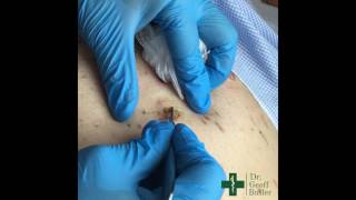 Removal of Seborrheic Keratosis [upl. by Shimkus]