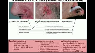 Anatomy  The Three Types of Skin Cancers [upl. by Deering345]