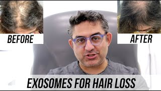 Exosomes for Hair Regrowth [upl. by Suzetta987]