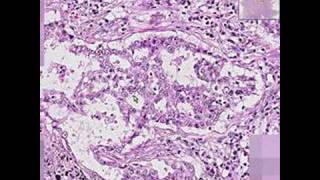 Histopathology Lung Adenocarcinoma [upl. by Steady]