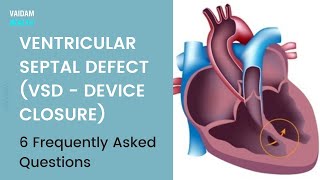 Ventricular septal defectVSD 6 Frequently Asked Questions [upl. by Ardnuahc]