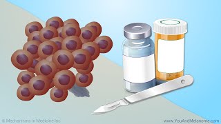 Treating Melanoma [upl. by Garry]