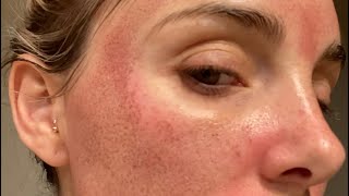 7 DAY AGGRESSIVE HALO LASER HEALING PROCESS [upl. by Aititel]