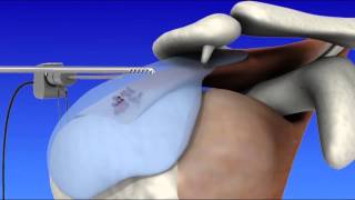 Shoulder Arthroscopy [upl. by Nynnahs375]