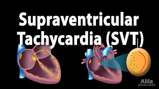 Supraventricular Tachycardia SVT PSVT Animation [upl. by Ysset]