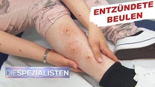 Beulen an den Beinen Parasitenbefall  Auf Streife  Die Spezialisten  SAT1 TV [upl. by Iddet362]