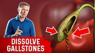 Do This to Help Dissolve Gallstones [upl. by Bisset]