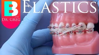 BRACES EXPLAINED Elastics  Rubber Bands [upl. by Mat223]