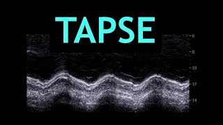 All about TAPSE Echocardiography [upl. by Udenihc134]