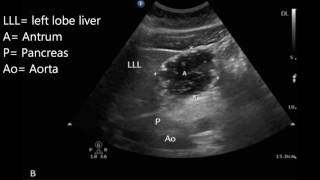 Gastroparesis Causes Signs and Symptoms Diagnosis and Treatment [upl. by Inittirb429]