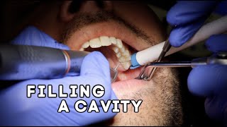 How Does A Dentist Fill A Cavity [upl. by Kahn]