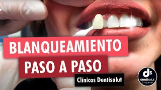 🦷😁 Blanqueamiento dental PASO A PASO 😁🦷 Antes y después  Clínica Dental Dentisalut [upl. by Portugal655]