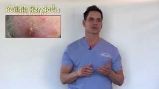 PreCancers or Actinic Keratosis Treatment Options With Dr Timothy Jochen [upl. by Lokkin698]