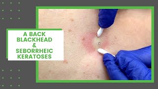 A Back Blackhead amp Seborrheic Keratoses  Dr Derm [upl. by Lemhar]