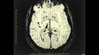 Susceptibility Weighted Imaging SWI  Canadian Magnetic Imaging [upl. by Otaner]