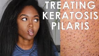 TREATING KERATOSIS PILARIS  3 EASY STEPS [upl. by Velleman]