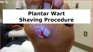 Plantar Wart Shaving Procedure [upl. by Nemracledairam343]