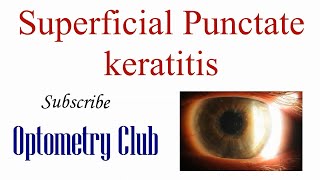 Superficial Punctate Keratitis Introduction Diagnosis and Treatment [upl. by Aciret]